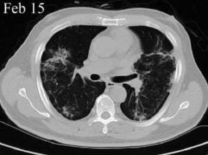 CT image after Stem Cell treatment