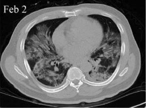 CT image before Stem Cell treatment