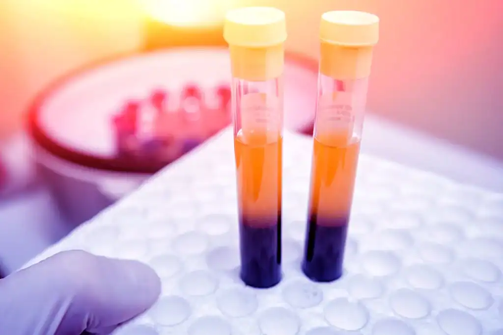 prp therapy newport beach ca