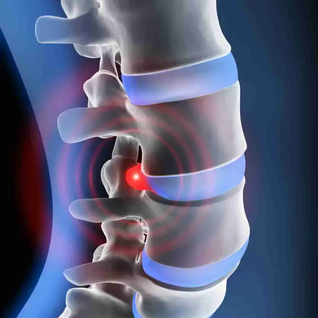 Disc Injury Treatment